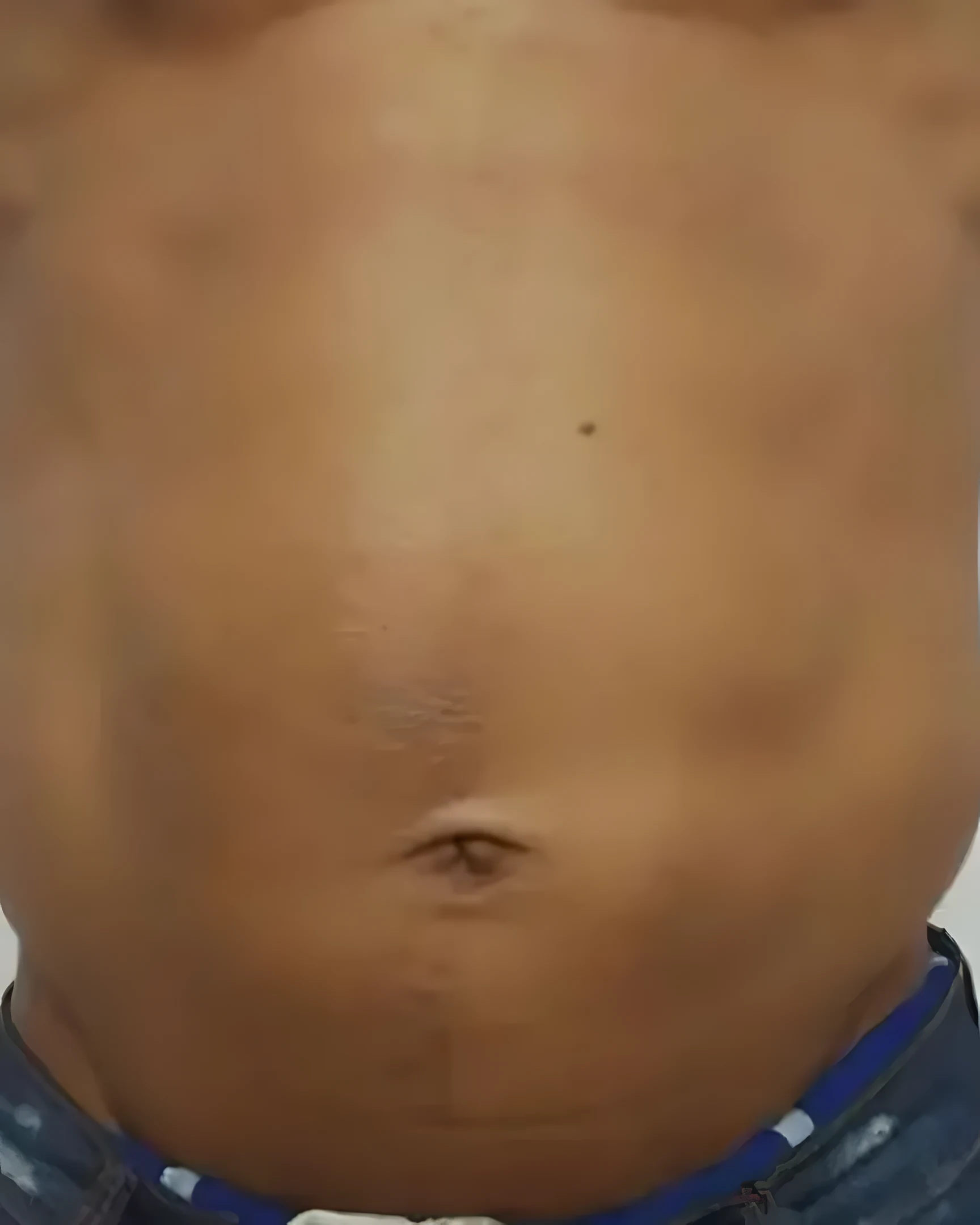 Abdômen frontal antes do Crioturbo