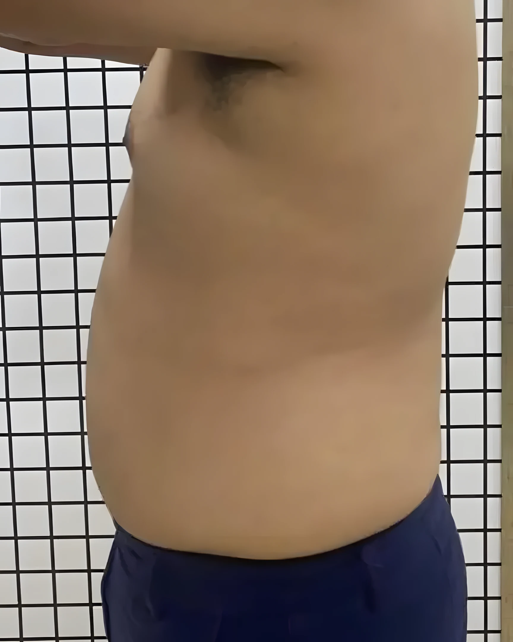 Abdômen de perfil antes do Crioturbo