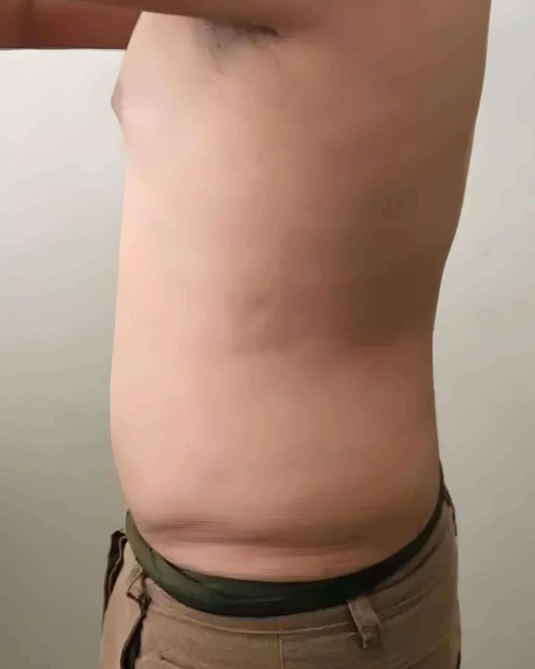 Abdômen de perfil depois do Crioturbo